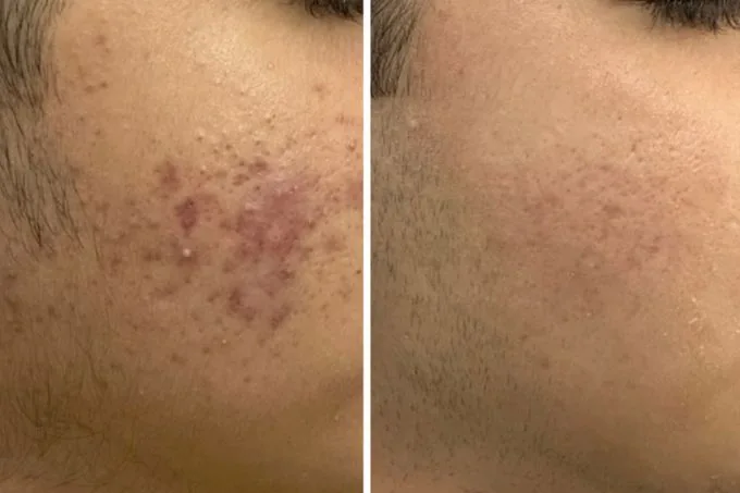 Acne and Scars Result